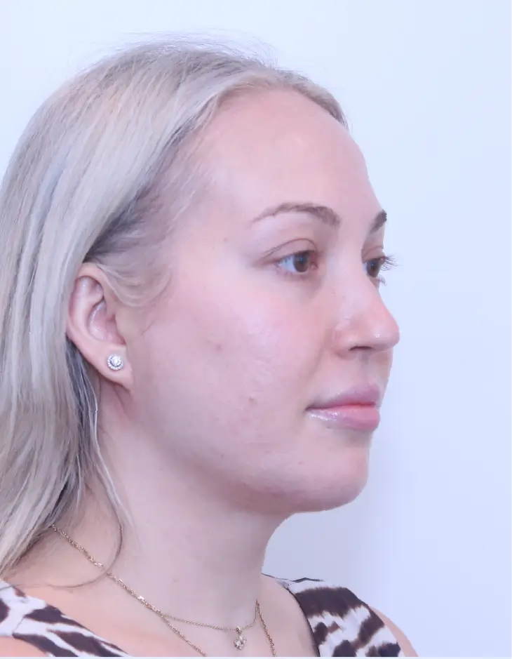 After Platysmaplasty Neck Lift surgery
