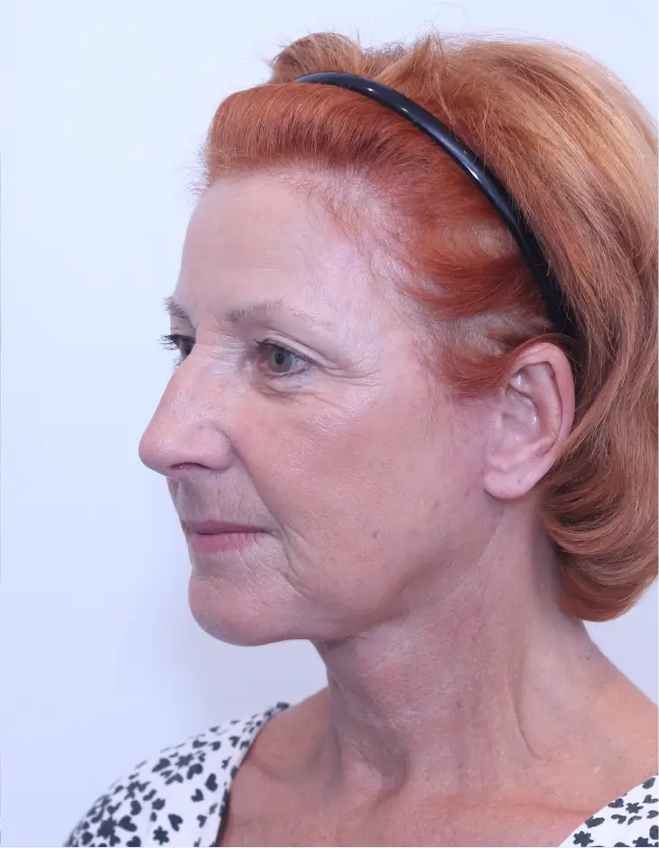 After Facelift + Neck Lift + Chin Implant surgery