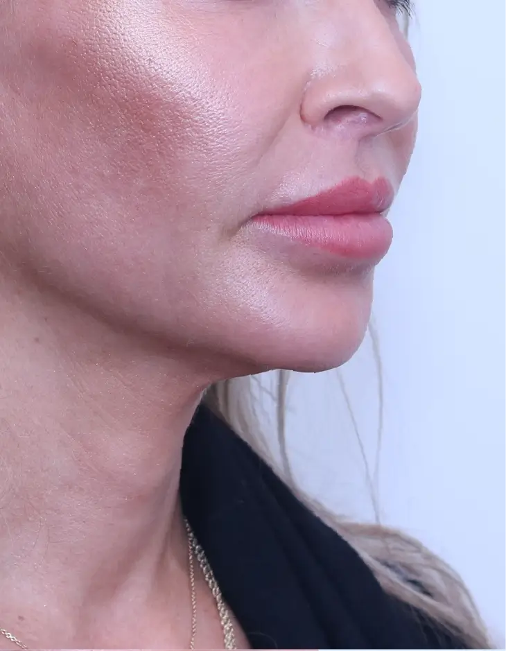 After Lip Lift surgery