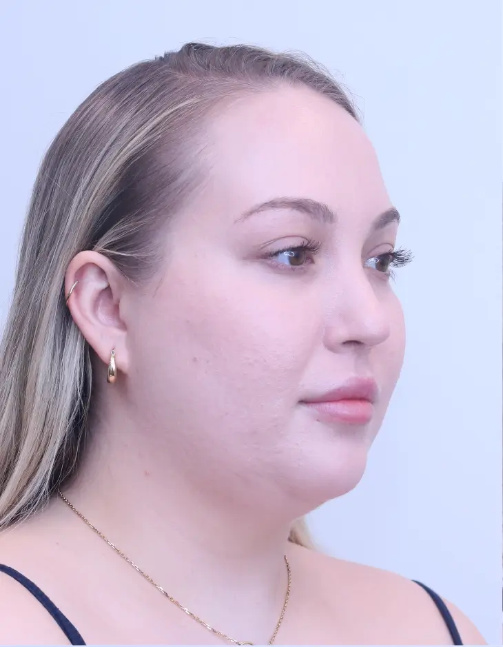 Before Platysmaplasty Neck Lift surgery
