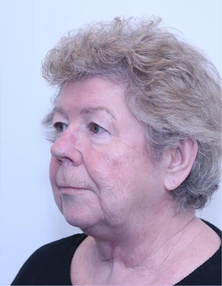 After Z-Plasty Neck Lift surgery