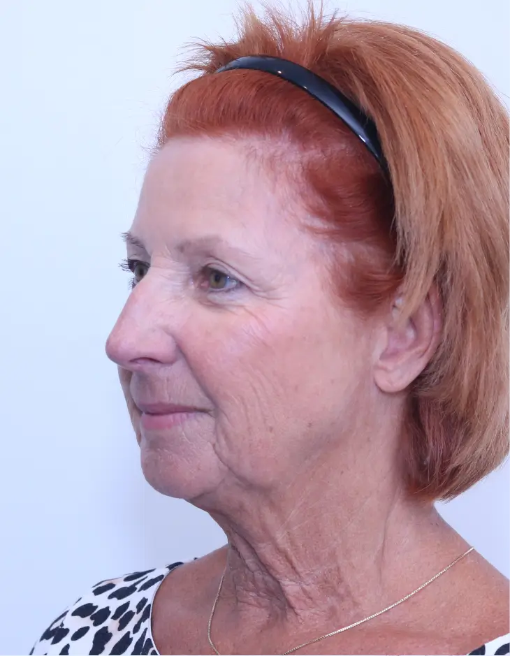 Before Facelift + Neck Lift + Chin Implant surgery