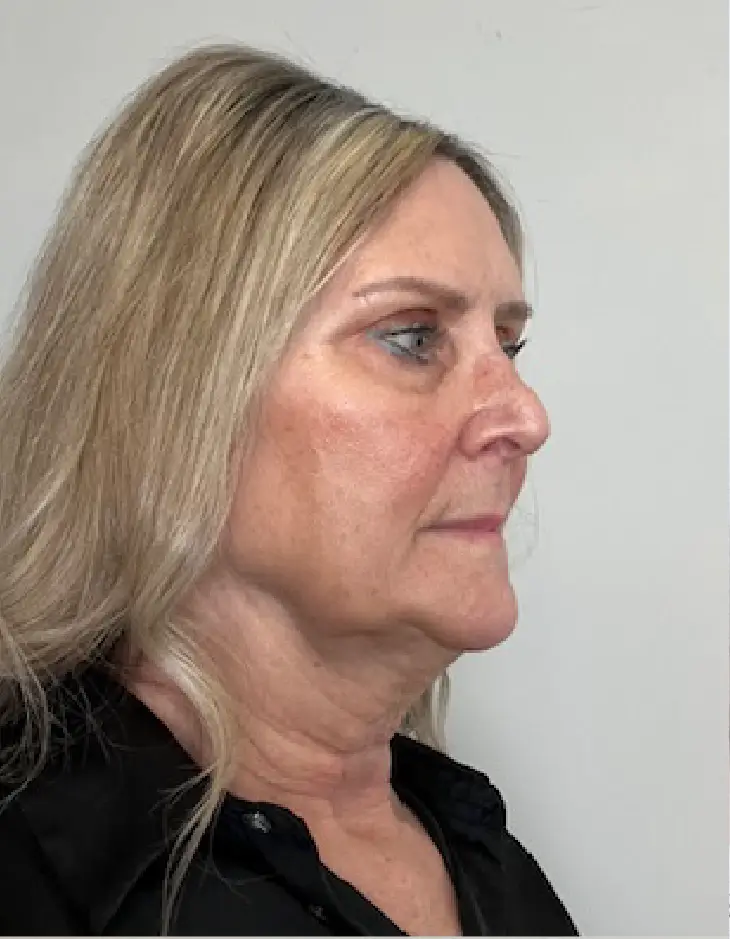 Before Facelift + Neck Lift surgery