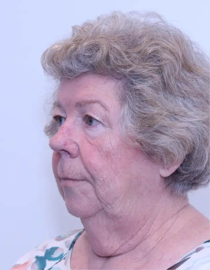 Before Z-Plasty Neck Lift surgery