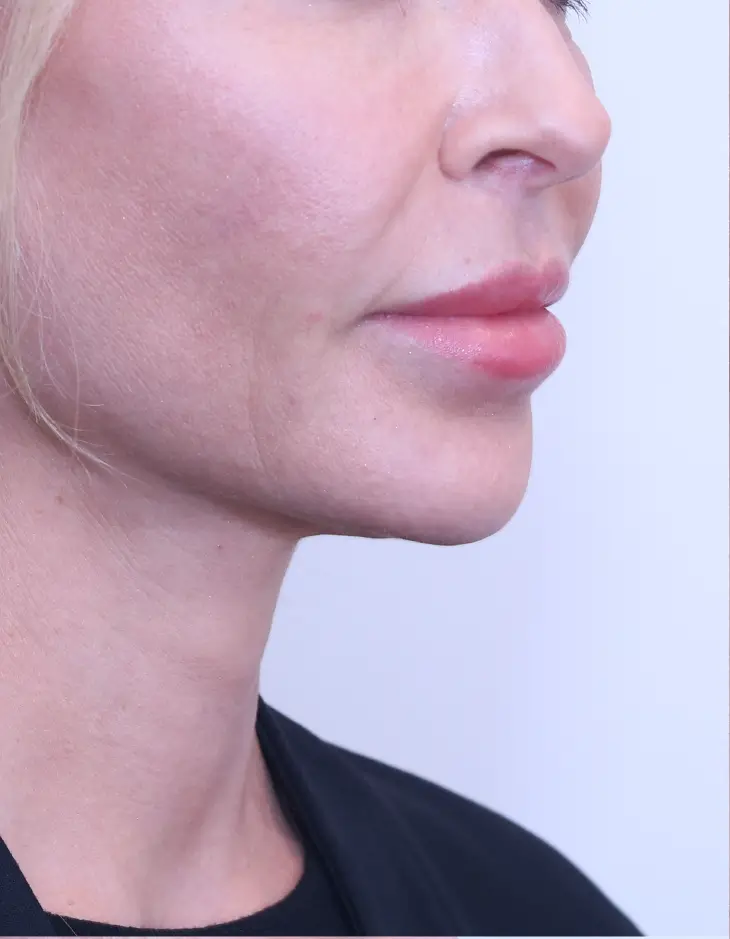 Before Lip Lift surgery