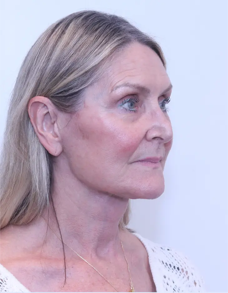 After Facelift + Neck Lift surgery