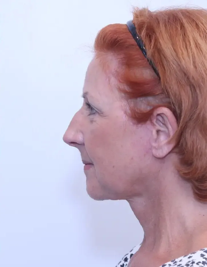 The same patient two months after a facelift, neck lift and chin implant with Dr. Buonassisi, side view