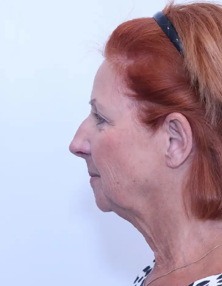 Patient before a facelift, neck lift and chin implant with Dr. Buonassisi, side view