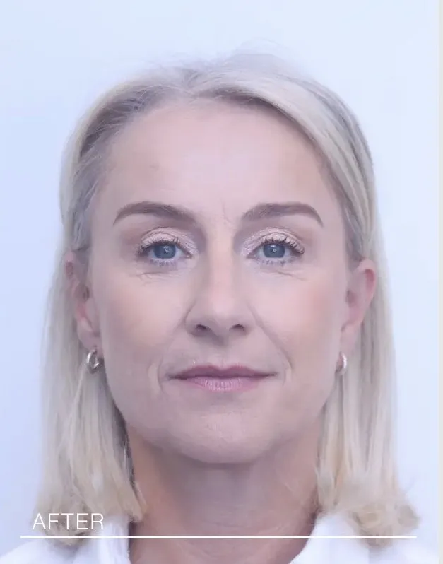 Nikki after upper blepharoplasty and direct brow lift, front view