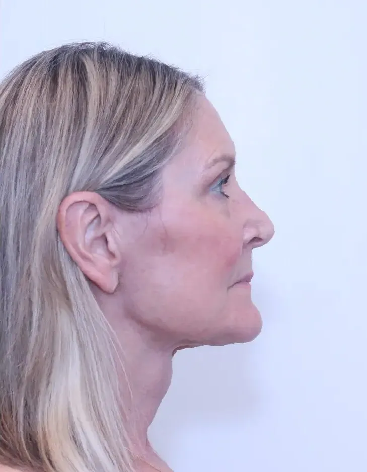 The same patient two months after a facelift and neck lift with Dr. Buonassisi, side view