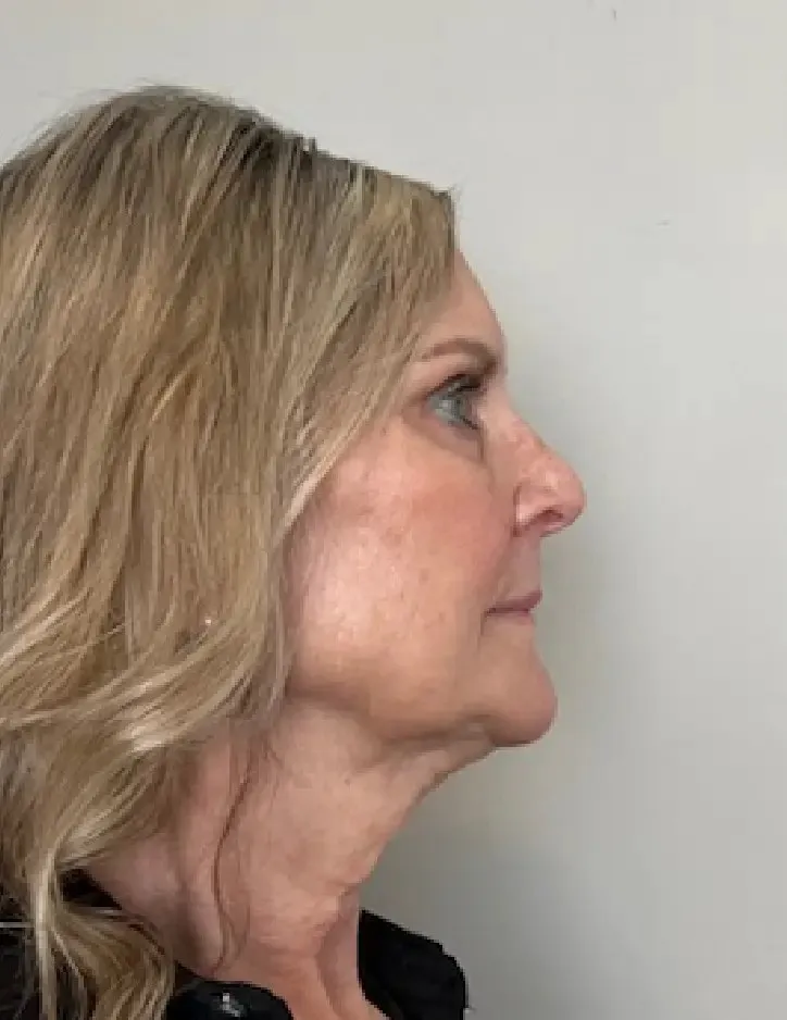 Patient before a facelift and neck lift with Dr. Buonassisi, side view