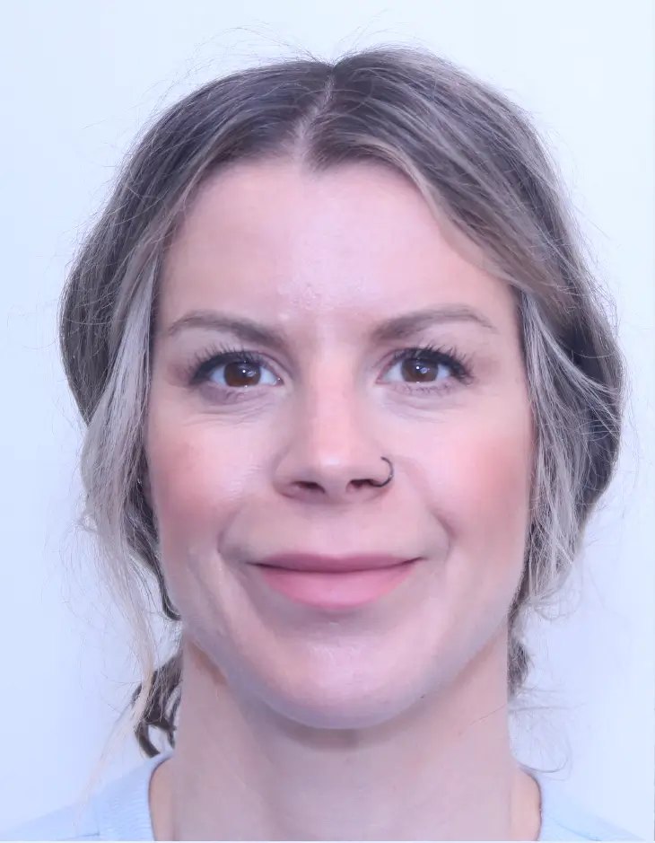 Patient before a lip lift with Dr. Buonassisi, front view