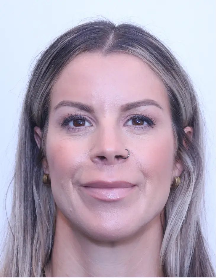 The same patient three months after a lip lift with Dr. Buonassisi, front view