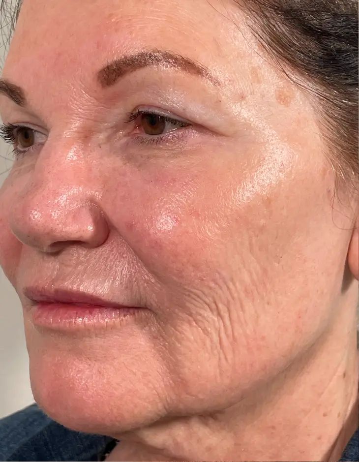 Before Contour TRL, three-quarter view of the face