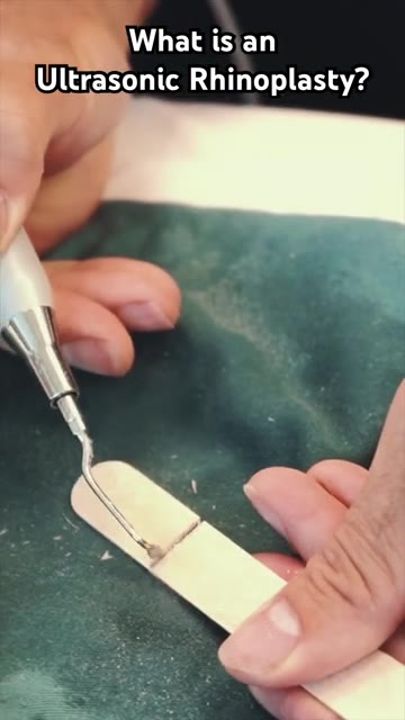 Ultrasonic Rhinoplasty Explained by Dr. Buonassisi at 8 West Clinic