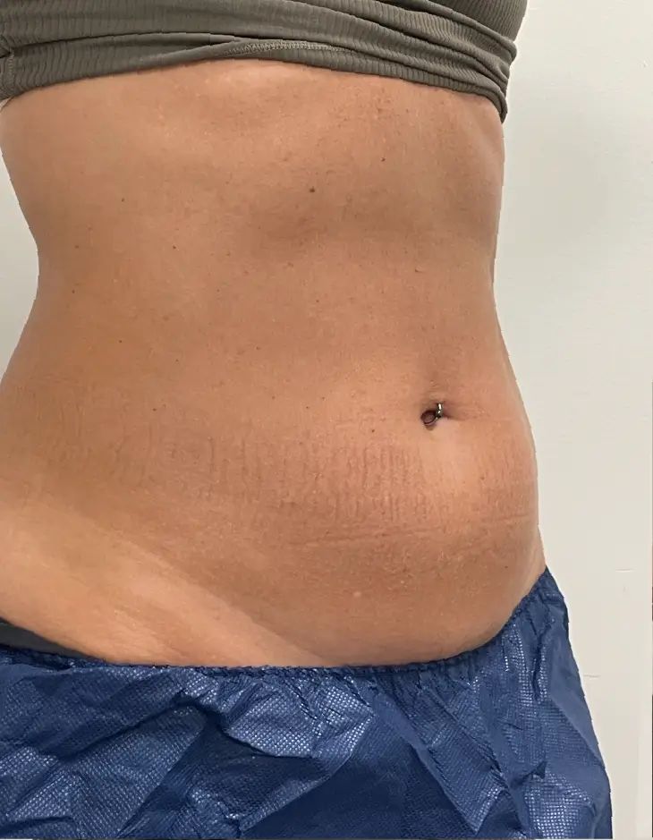 Before Emsculpt NEO, abdomen, three-quarter view