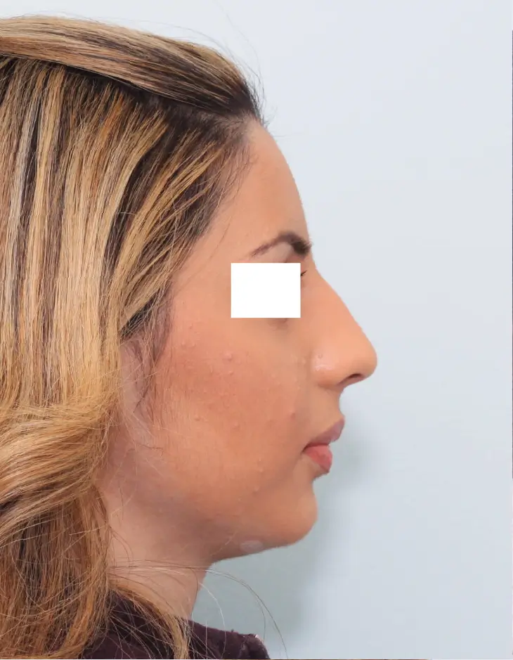 Before rhinoplasty, side view