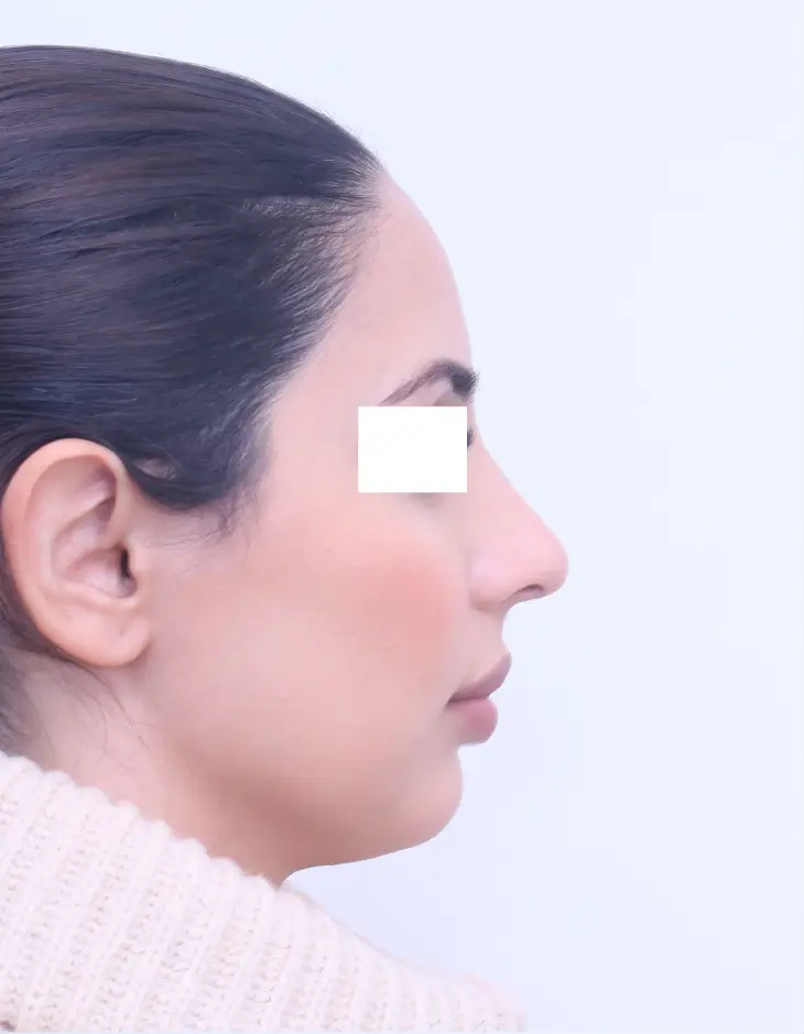 After rhinoplasty, side view, 8 years after surgery