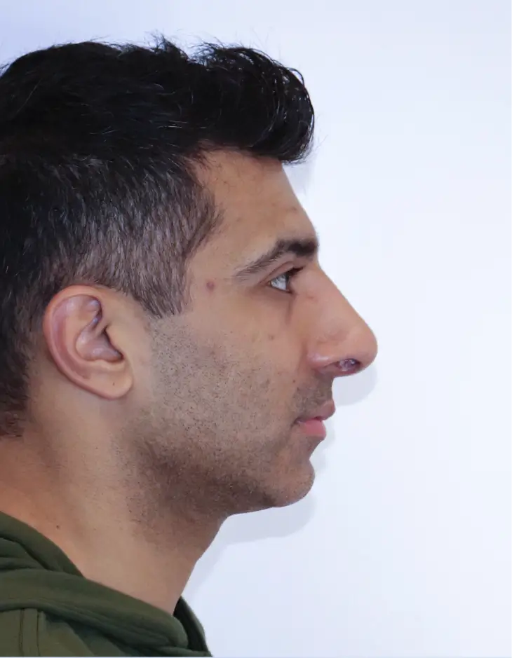 After rhinoplasty, side view, 2 months after surgery