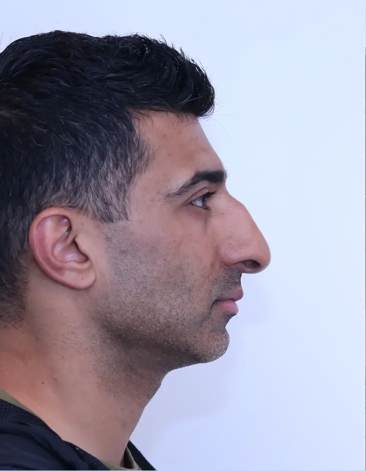 Before rhinoplasty, side view