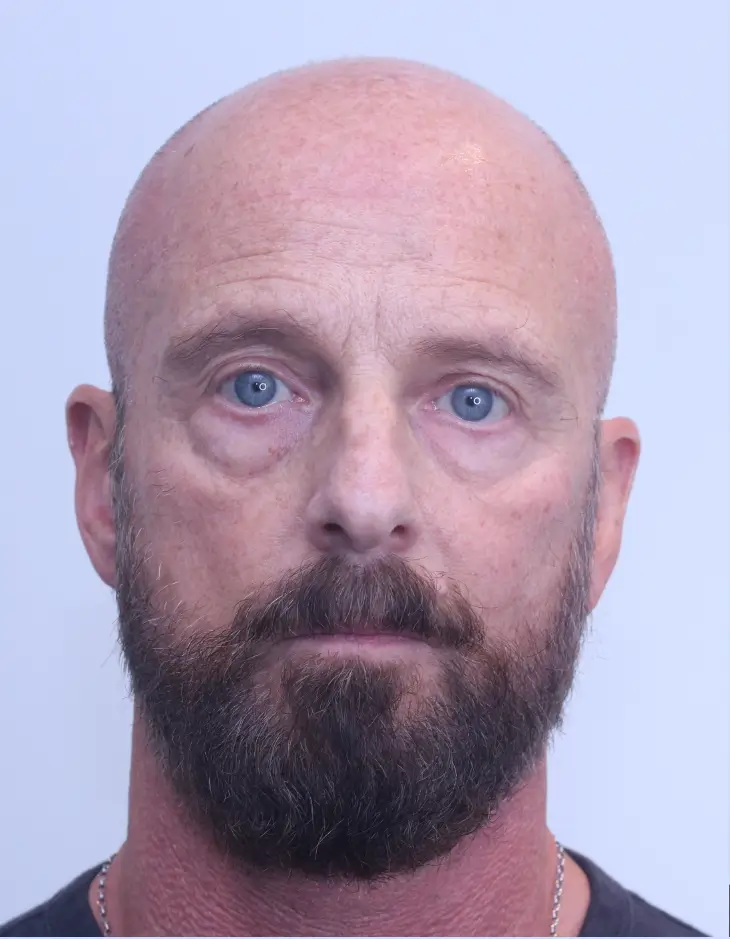 Lower blepharoplasty, before