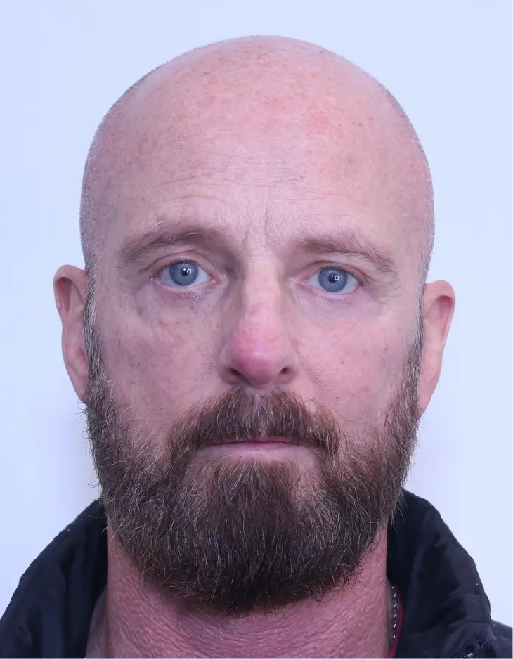 Lower blepharoplasty, after