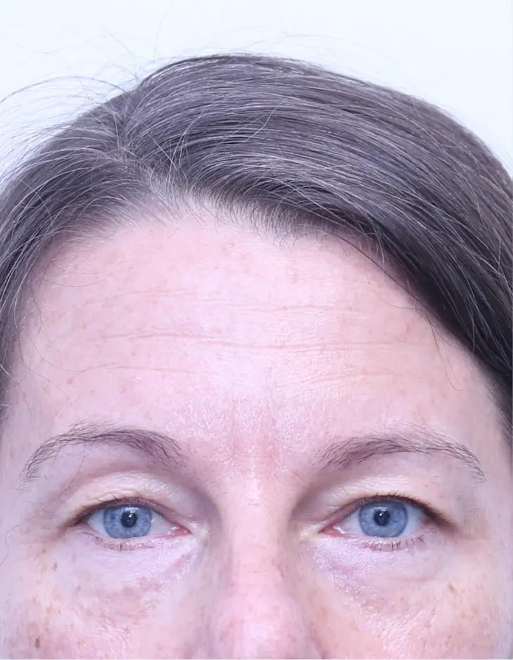 Upper blepharoplasty, before