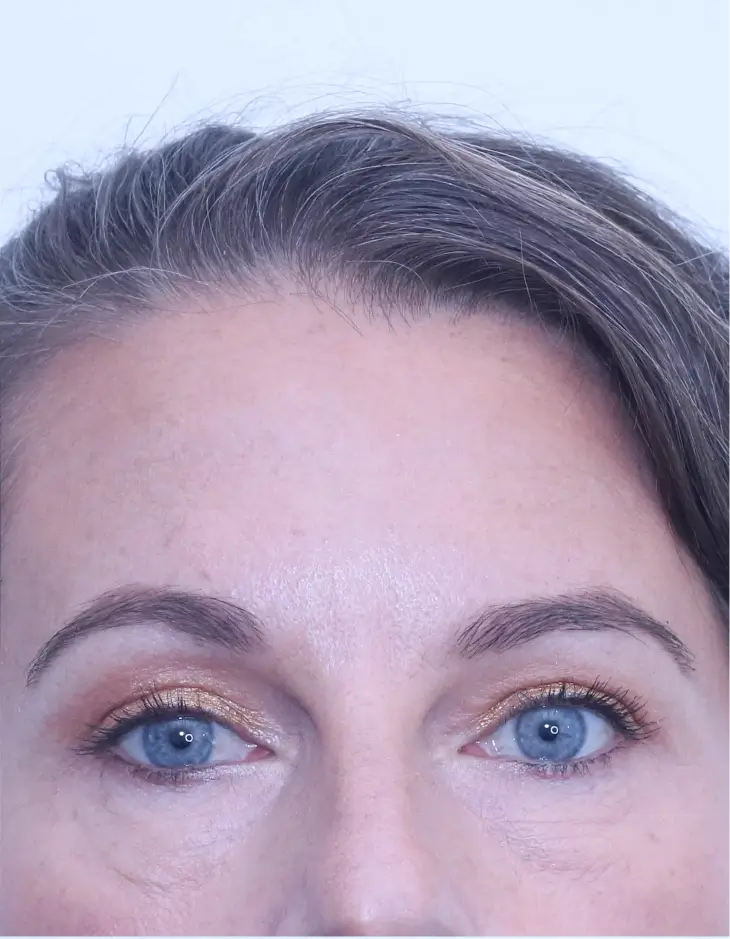 Upper blepharoplasty, after