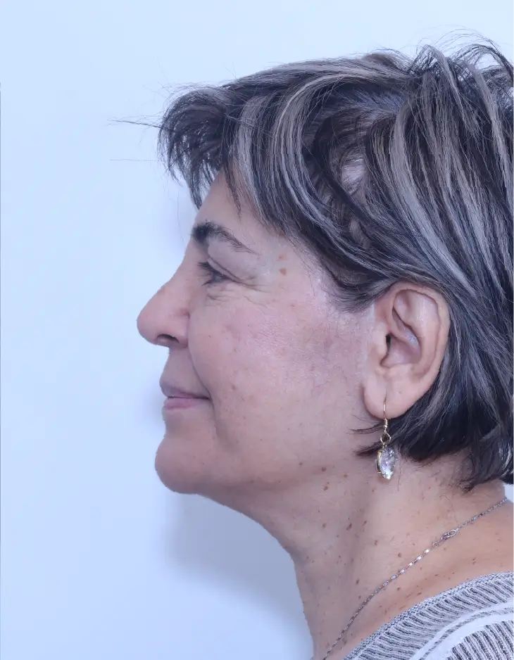 Facelift and neck lift, after