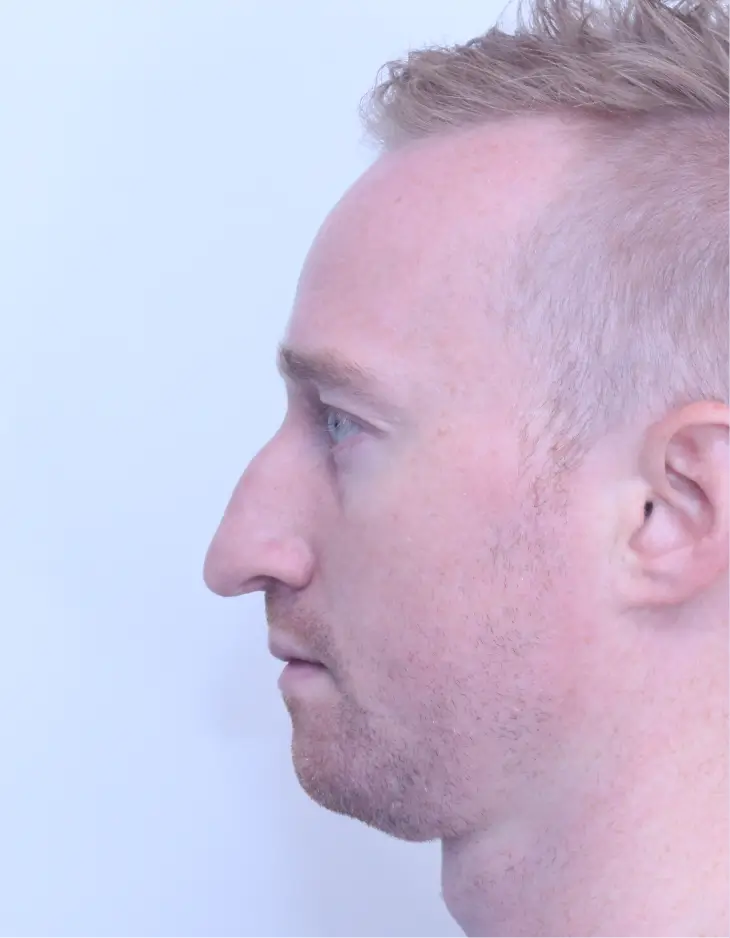 Rhinoplasty, before