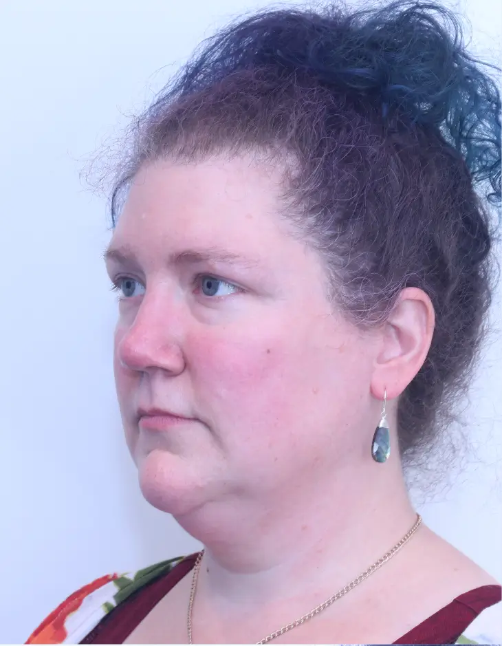 Neck lift (platysmaplasty), before