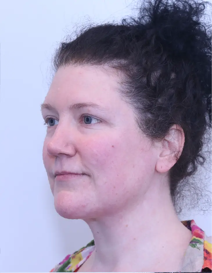 Neck lift (platysmaplasty), after