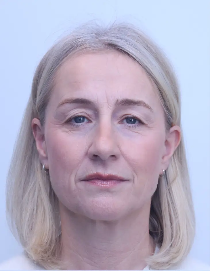 Upper blepharoplasty and brow lift, before