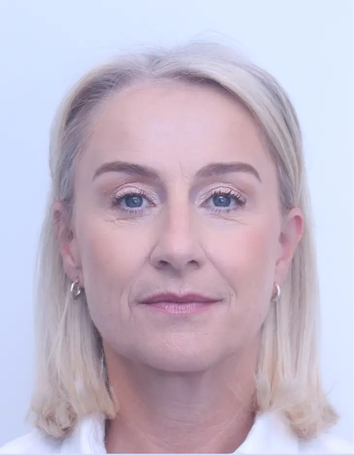 Upper blepharoplasty and brow lift, after