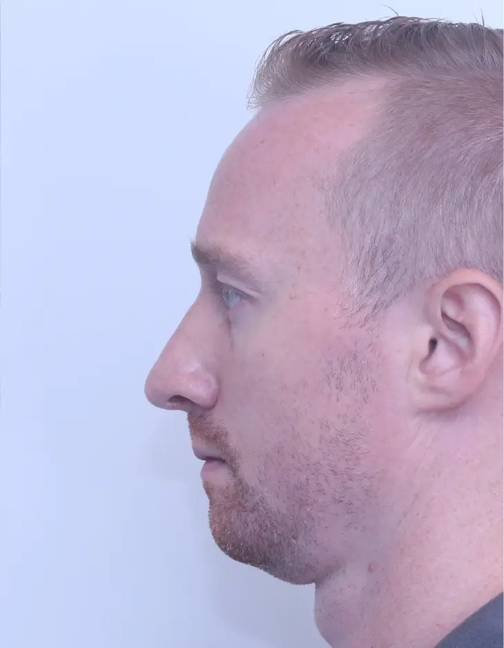 Rhinoplasty, after