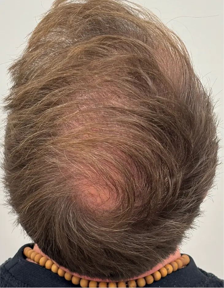 After TED, top view of the scalp