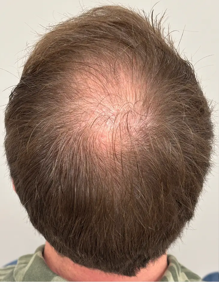 Before TED, top view of the scalp