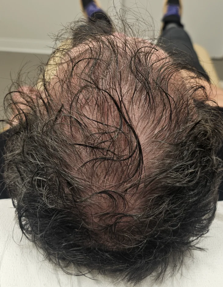 After TED, top view of the scalp