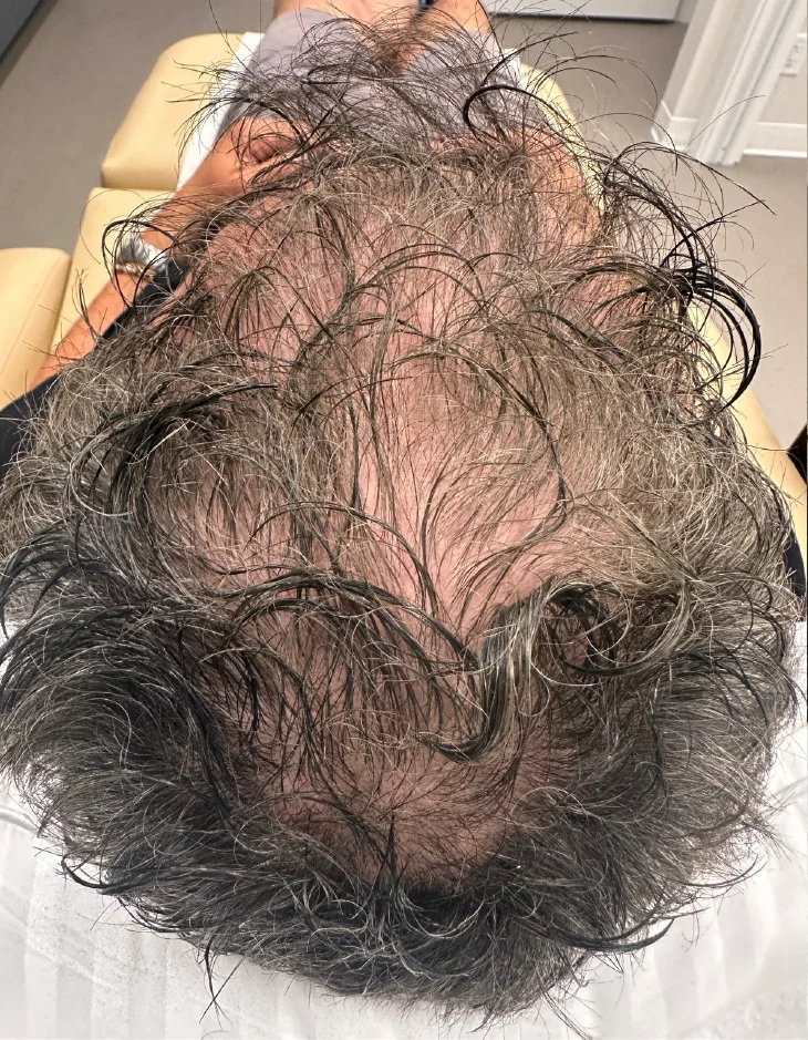 Before TED, top view of the scalp