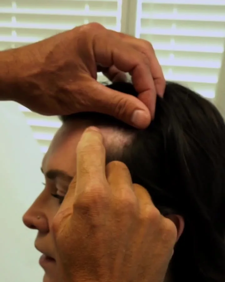 Dr. Buonassisi pointing to Jenn's incision line at the hairline