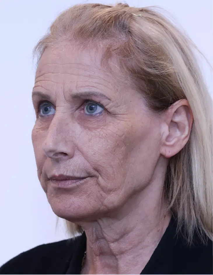 Facelift, neck lift, upper blepharoplasty and brow lift, before, three-quarter view