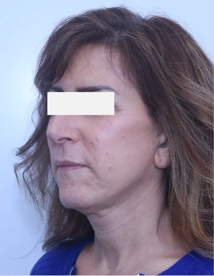 Facelift, after, three-quarter view