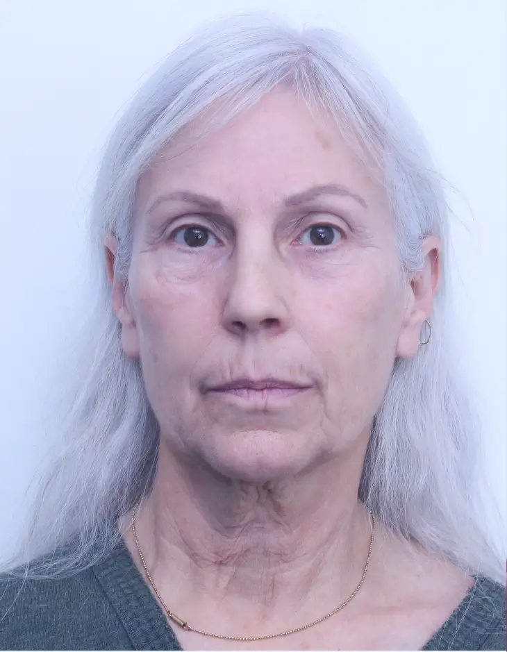 Facelift and neck lift, before, front view