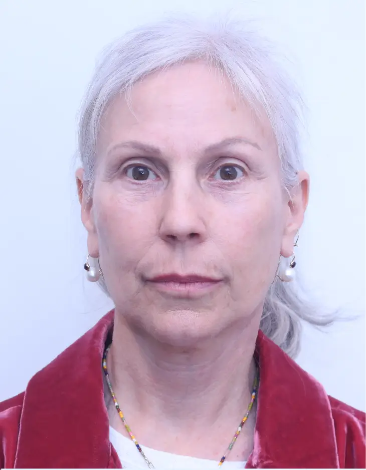 Facelift and neck lift, after, front view