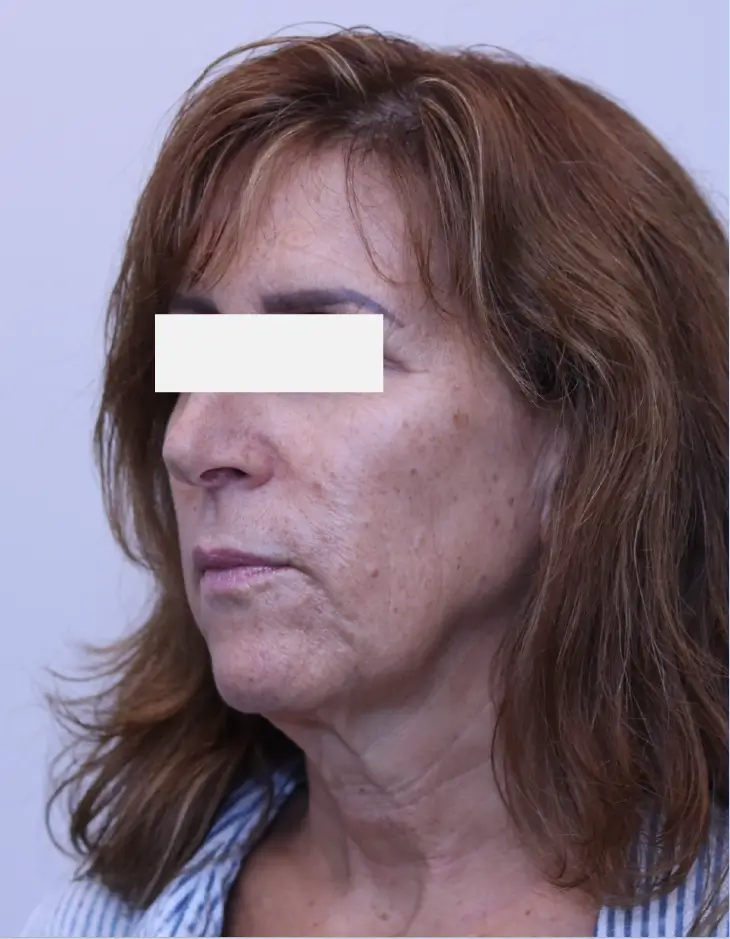 Facelift, before, three-quarter view