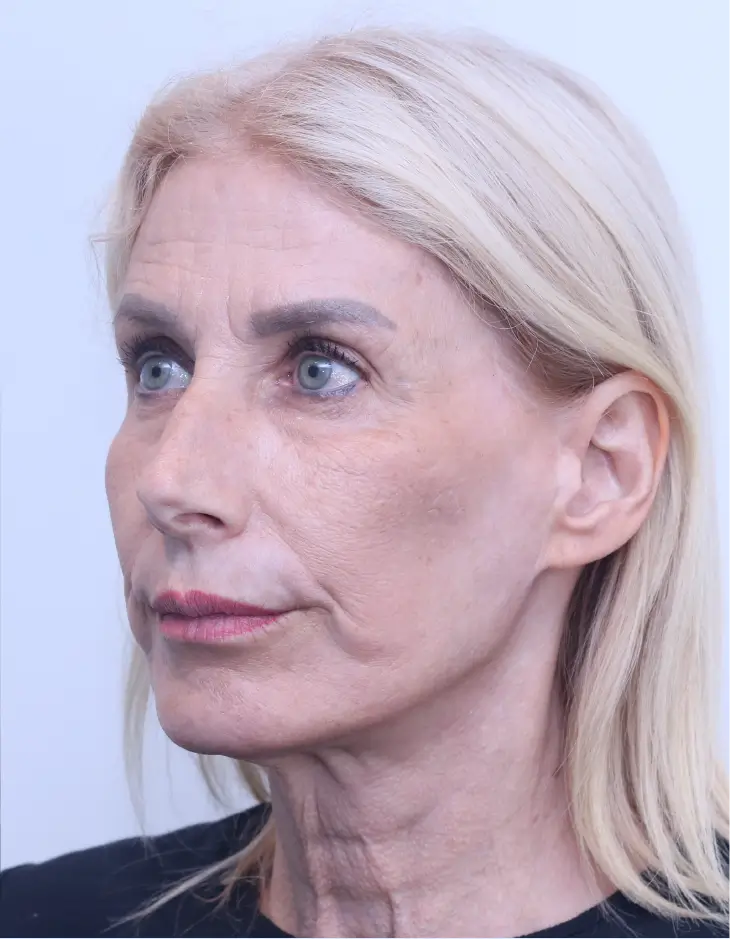 Facelift, neck lift, upper blepharoplasty and brow lift, after, three-quarter view
