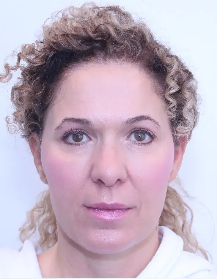 Upper blepharoplasty and brow lift, after, front view