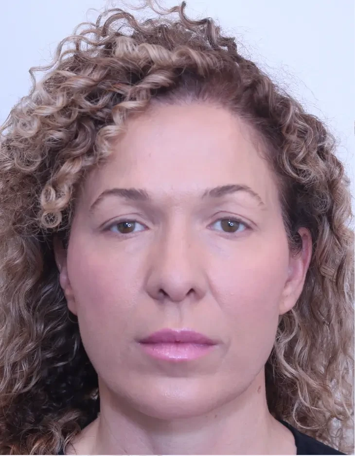 Upper blepharoplasty and brow lift, before, front view