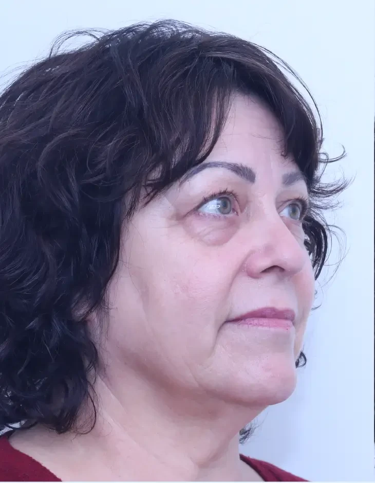 Lower blepharoplasty, before, partial side view