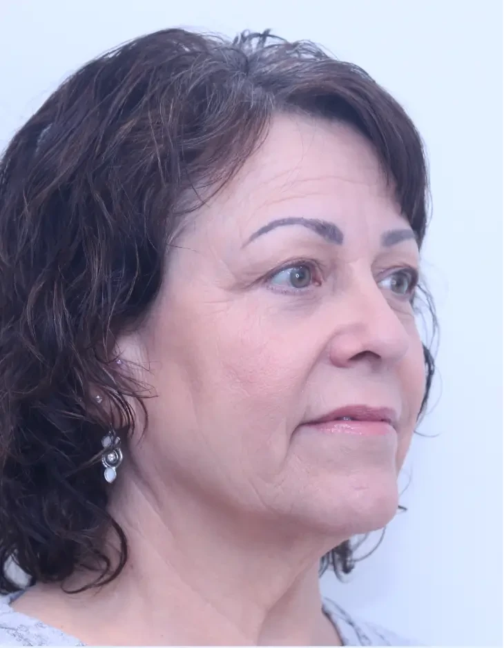 Lower blepharoplasty, after, partial side view
